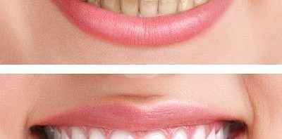علاج إصفرار الاسنان من خلال بيكربونات الصوديوم   استخدامات بيكربونات الصوديوم للاسنان